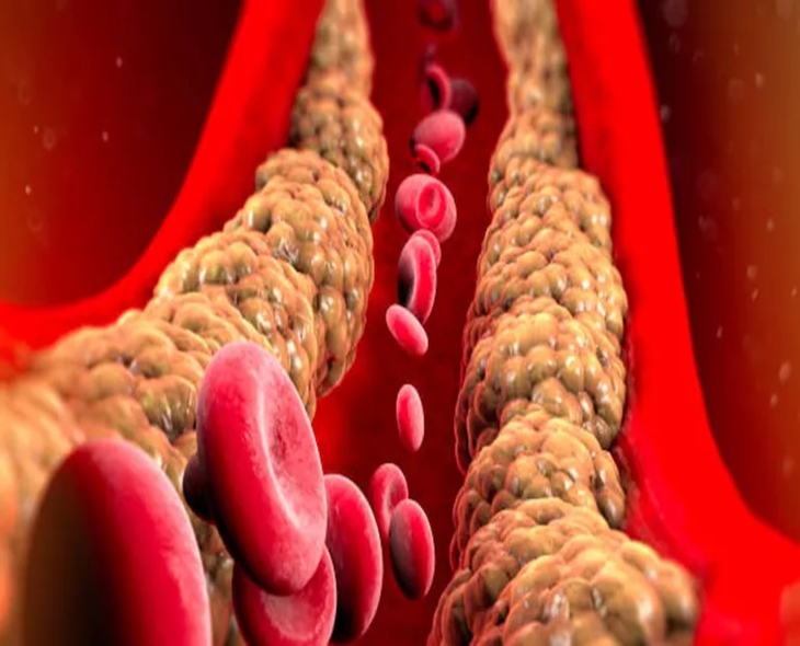 Effective Tips To Lower Cholesterol Beyond Statins