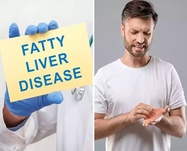 Warning Signs Of Fatty Liver You Shouldn’t Ignore