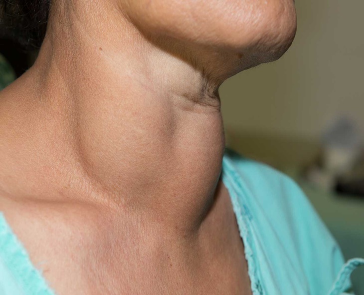 Thyroid Cases Trigger Concern: Easy Ayurveda Remedies To Stay Healthy