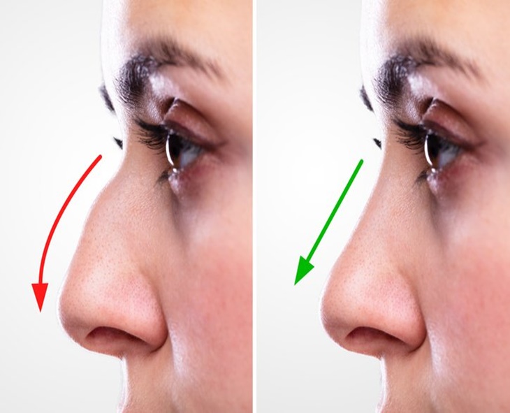 The Truth About Nose Jobs: Modern Rhinoplasty Explained
