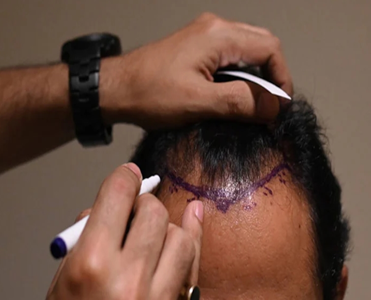 Hair Transplant Myths vs Facts: What You Should Know