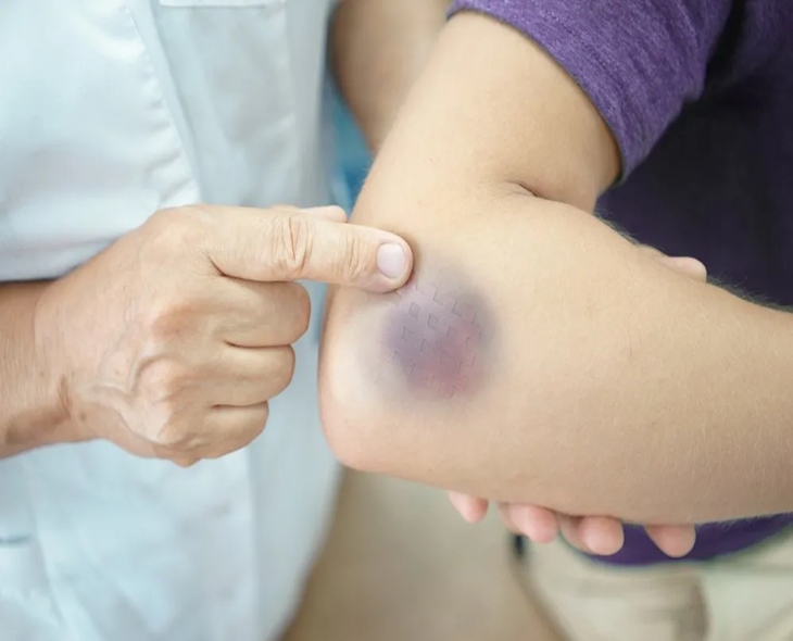 Blue Bruises Under Skin: Causes You Should Know