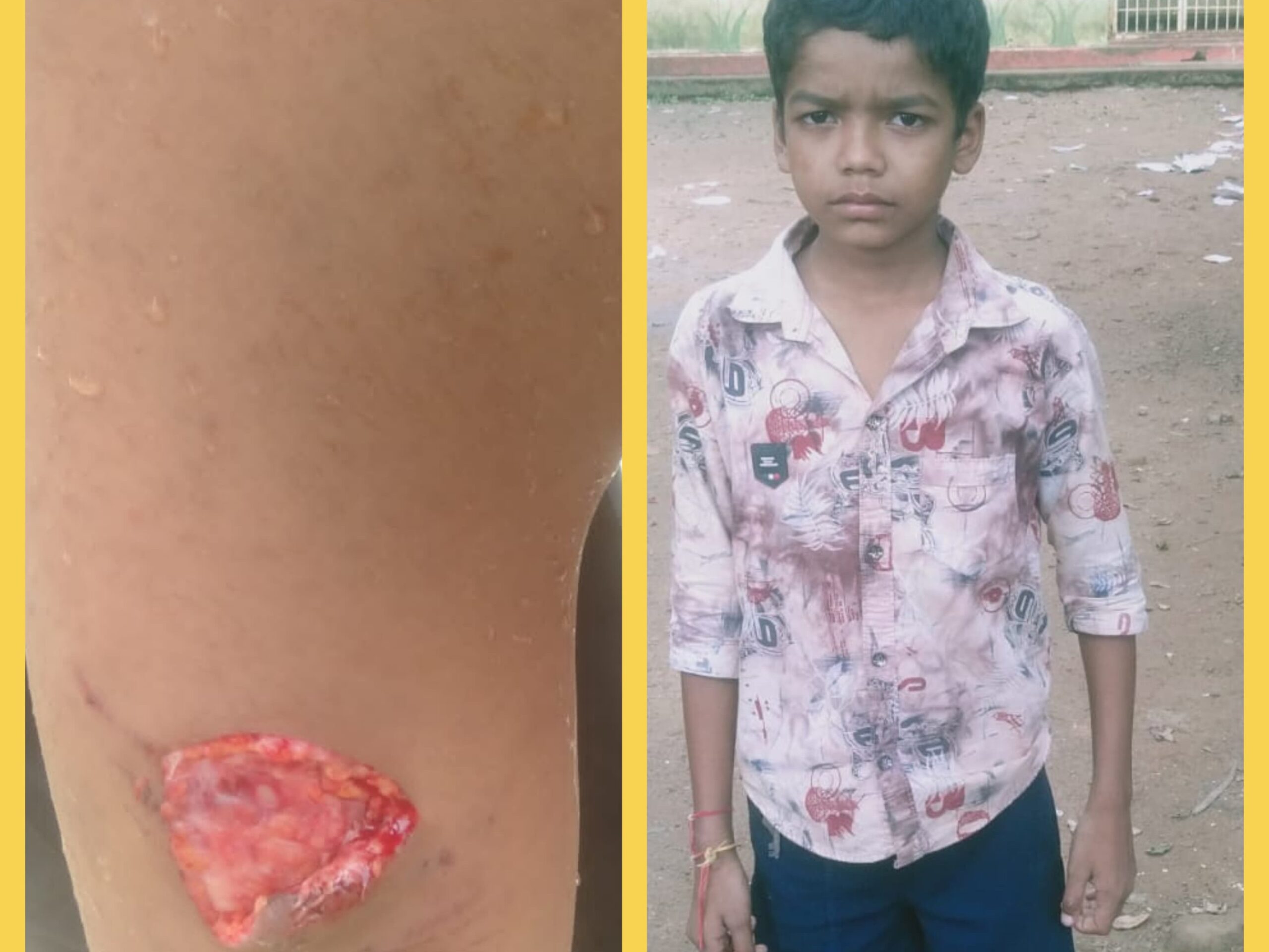 పిచ్చి కుక్క దాడిలో బాలుడికి గాయాలు