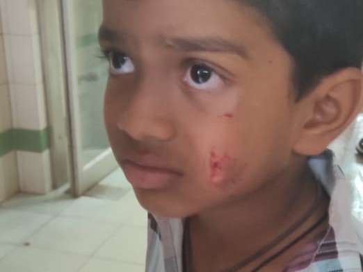 కుక్క కాటుతో విద్యార్థికి గాయాలు
