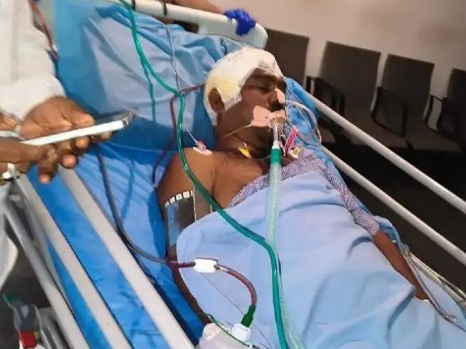 ఓసిపి-3 లో ప్రమాదం… సింగరేణి కార్మికుడికిగాయాలు