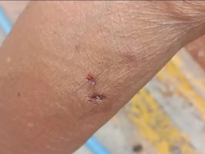 వీధి కుక్క దాడిలో వృద్ధురాలికి గాయాలు