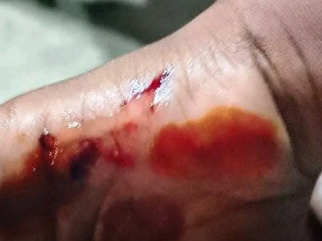 వీధి కుక్కల దాడిలో చిన్నారులకు గాయం