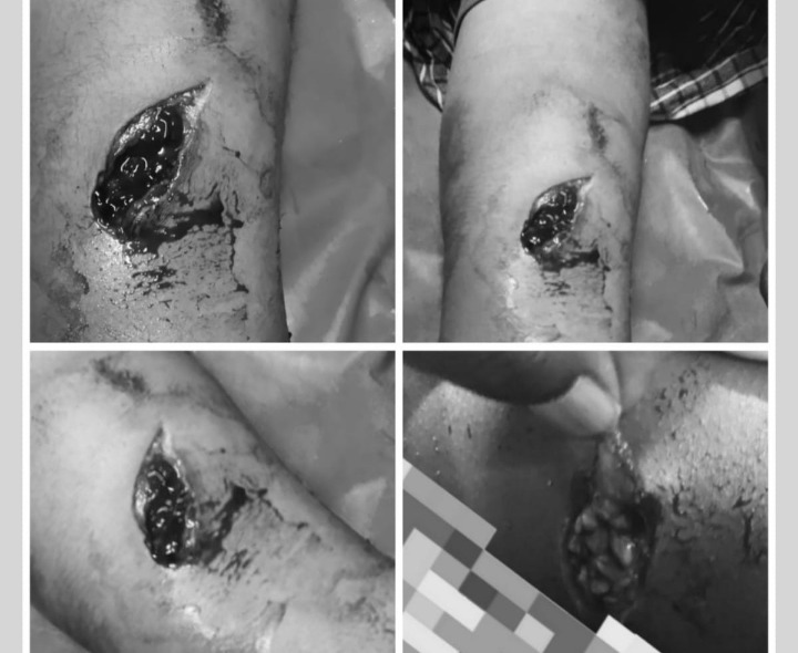 యువకుడిపై అడవి పంది దాడి