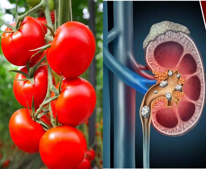 టమోటా తింటే కిడ్నీలో రాళ్లు వస్తాయా?