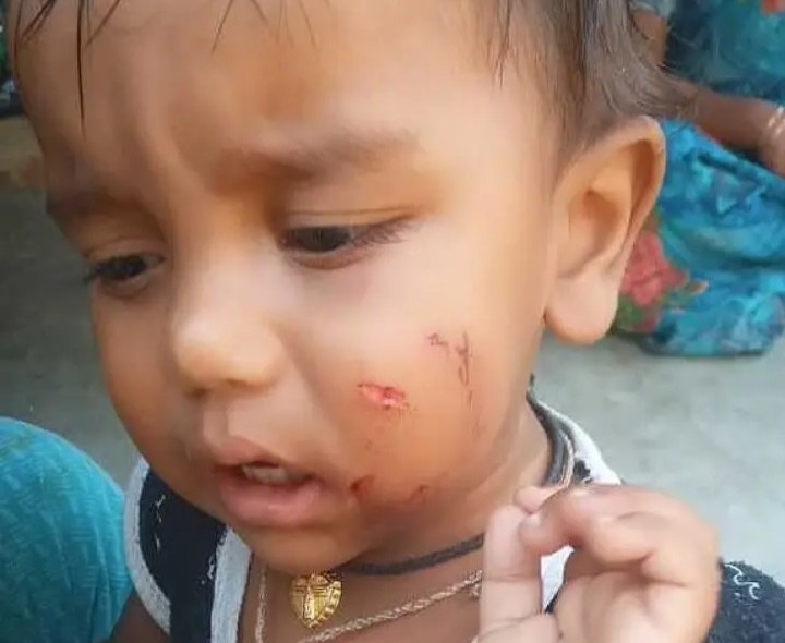 పిచ్చికుక్క దాడిలో చిన్నారికి గాయాలు