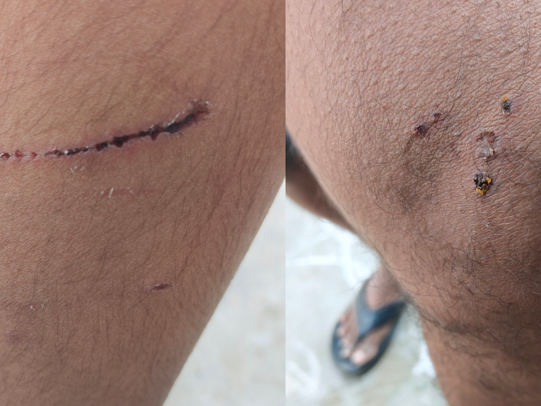 చిన్నారిపై కుక్క దాడి