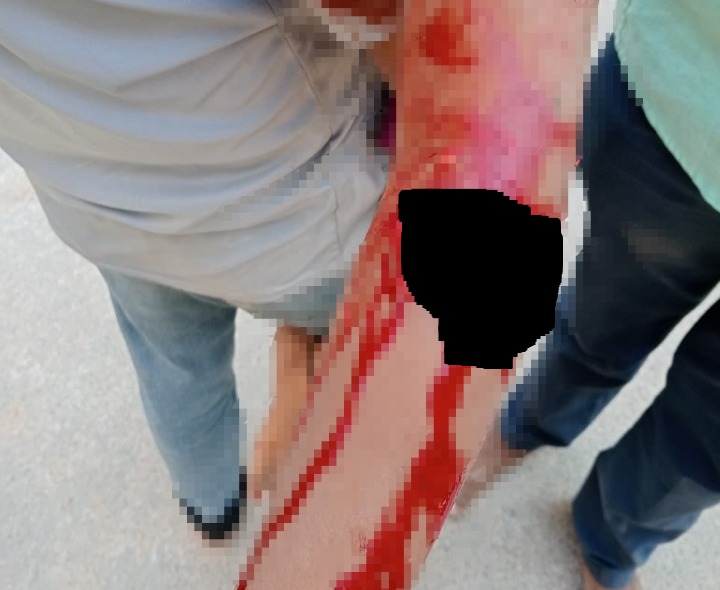 పిచ్చికుక్కల దాడిలో బాలుడికి తీవ్ర గాయాలు