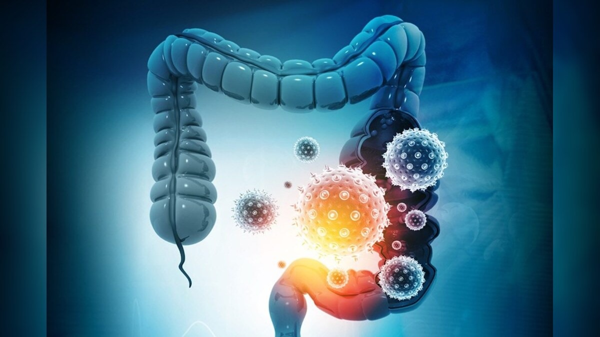 యువతకూ పేగు క్యాన్సర్ ముప్పు!