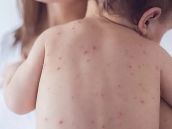 దర్శి నియోజకవర్గంలో చికెన్ పాక్స్ (ఆటలమ్మ)