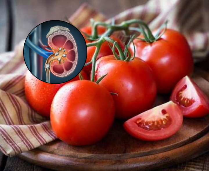 టమాటాలు తింటే కిడ్నీలో రాళ్లు వస్తాయా?