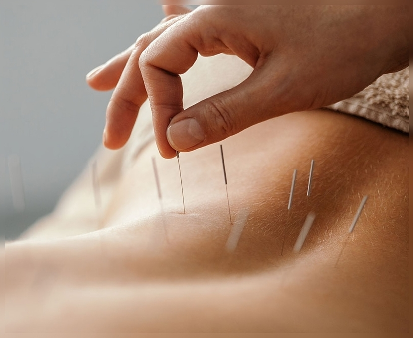 అక్యూపంక్చర్.. సూదులతో రోగాలకు చెక్