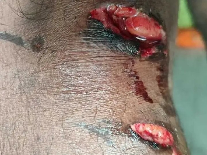 కుక్కల దాడిలో వ్యక్తికి తీవ్ర గాయాలు