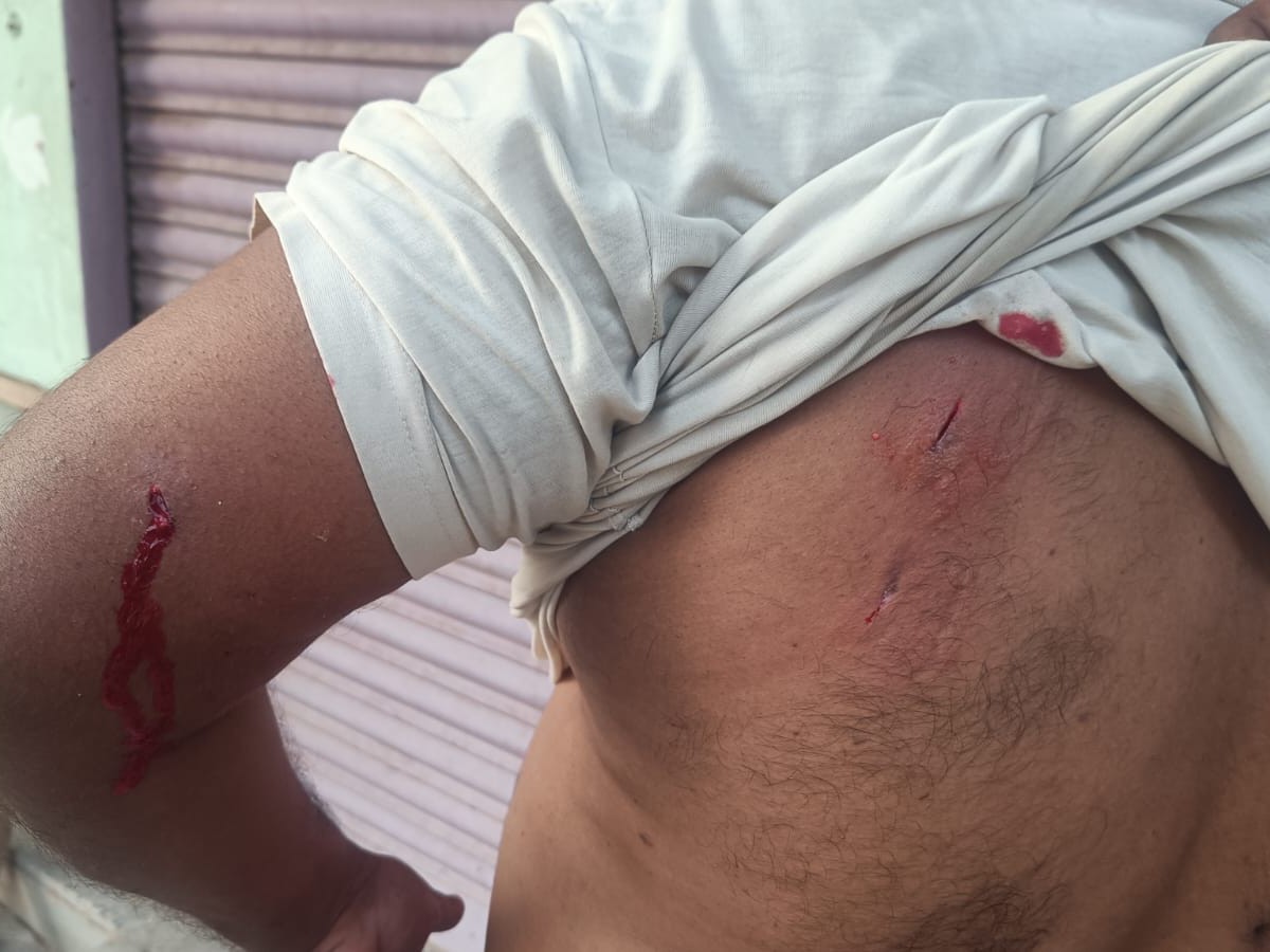 కోతుల దాడిలో వ్యక్తికి తీవ్ర గాయాలు