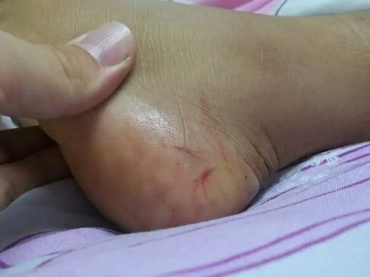 ఏనుమాముల మార్కెట్లో పాముకాటు కలకలం