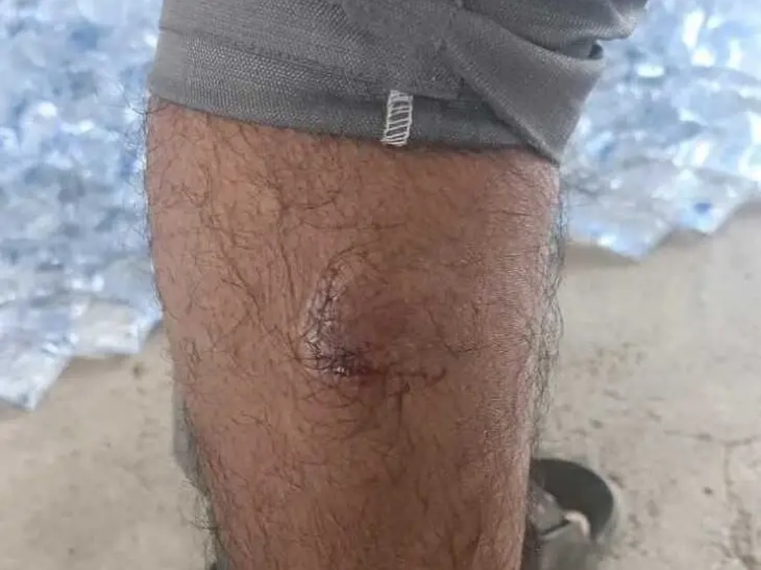 పిచ్చికుక్క దాడిలో వ్యక్తికి గాయం