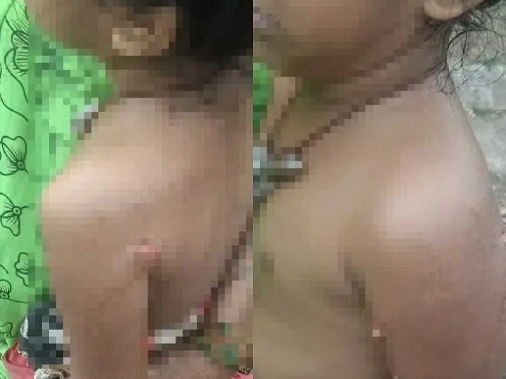 రెండేళ్ల చిన్నారి పై వీధి కుక్కల దాడి..!