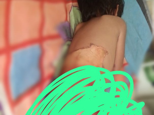 వేడి నీటిలో పడిన చిన్నారి..