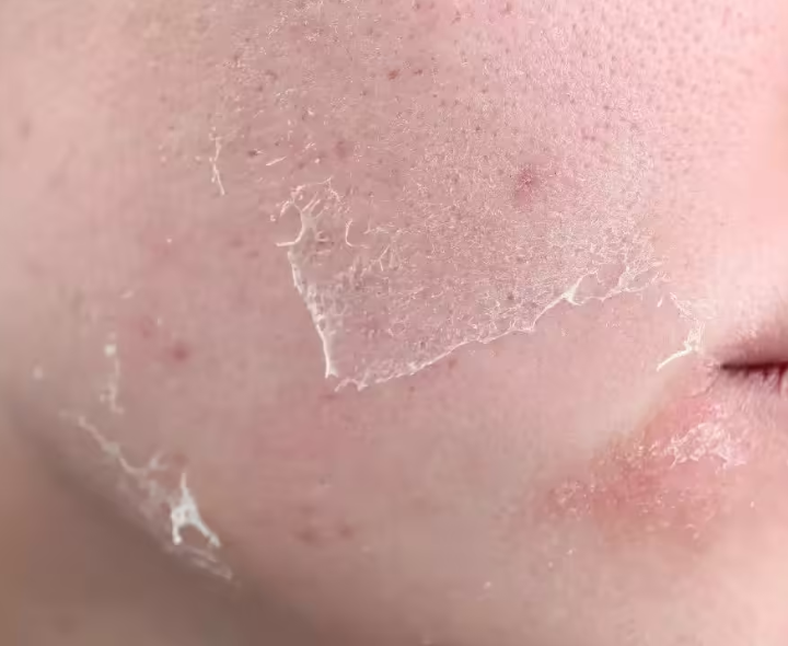 చర్మ కోసం స్టిరాయిడ్స్ వాడుతున్నారా?