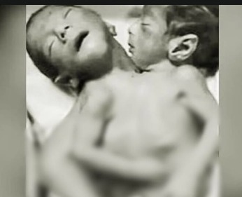 ఒకే ప్రాణం.. రెండు తలలు.. వింత శిశువు!