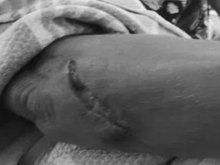 చెర్వు అన్నారంలో కోతుల దాడి.. మహిళకు తీవ్ర గాయాలు