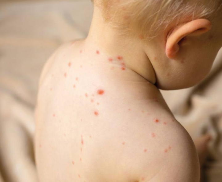 చికెన్ పాక్స్ ఒక్కసారే ఎందుకు వస్తుంది?