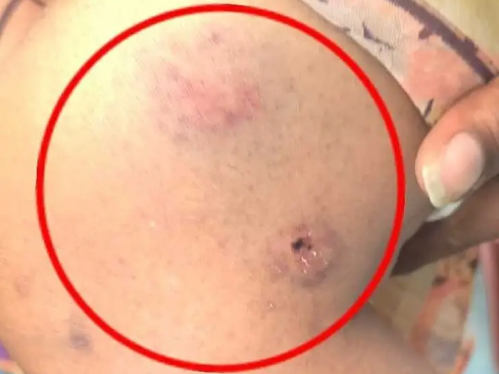 వృద్ధురాలు పై కోతులు దాడి