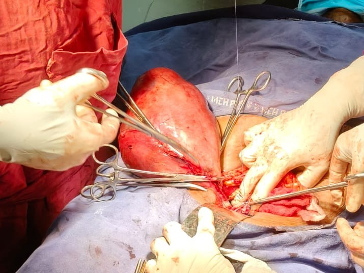 ‘ప్రభుత్వ ఆసుపత్రిలో అరుదైన ఆపరేషన్’