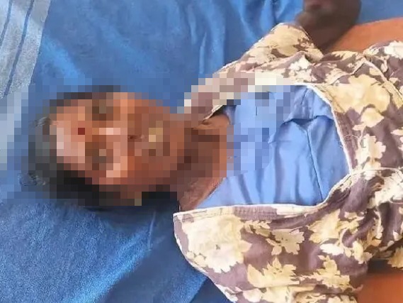 పొయ్యి మంట అంటుకుని మహిళకు తీవ్ర గాయాలు