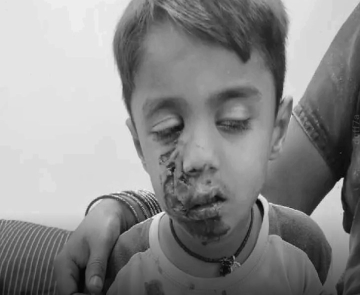 నకిరేకల్‌లో బాలుడిపై కుక్కల దాడి