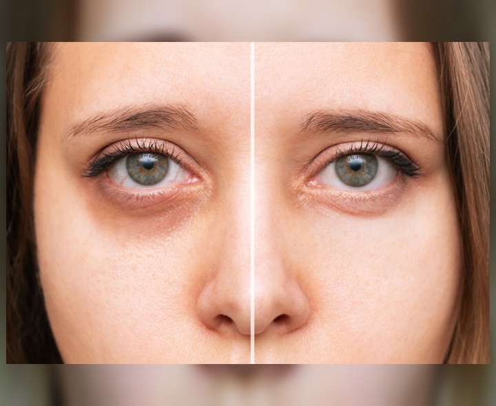 కళ్ల కింద నల్లటి వలయాలు తగ్గాలంటే..!