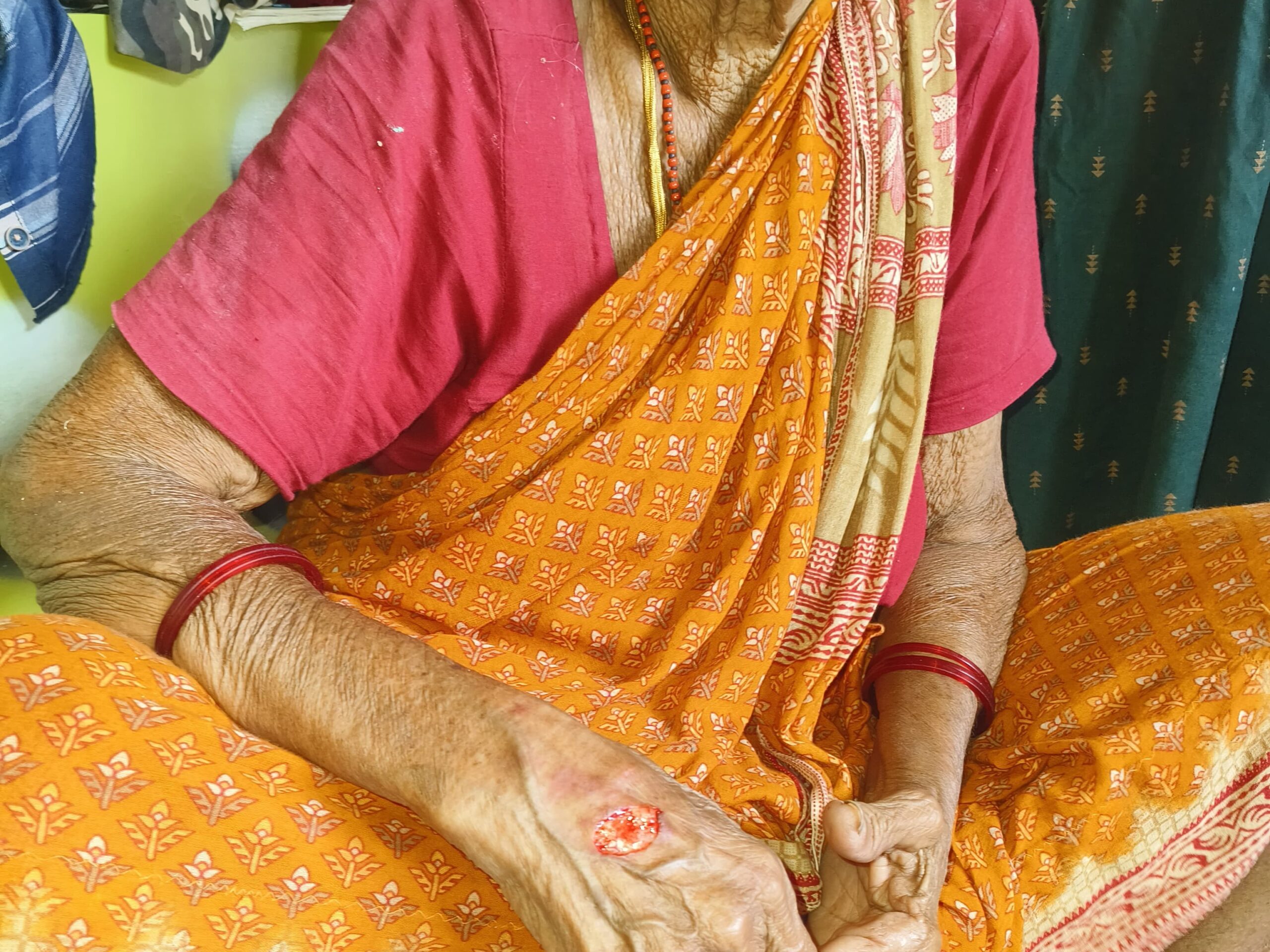 కోతుల దాడిలో గాయపడిన వృద్ధురాలు