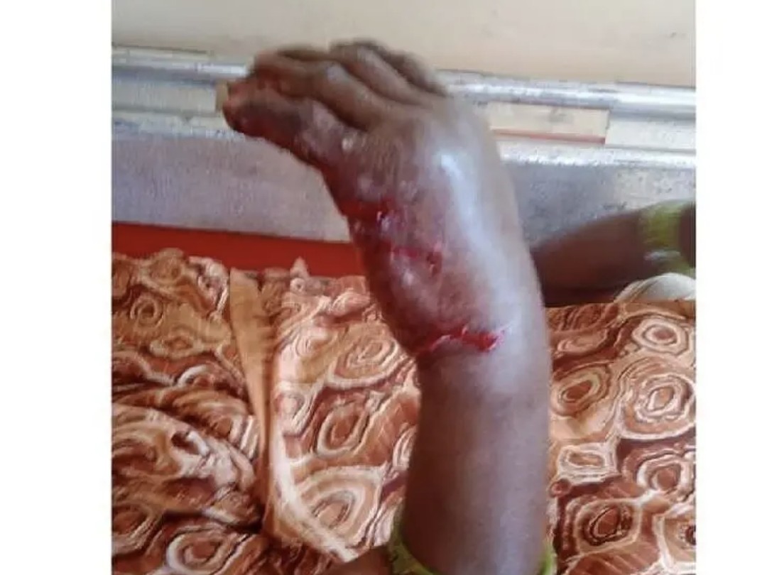 పిచ్చికుక్క దాడి.. మహిళకు గాయాలు