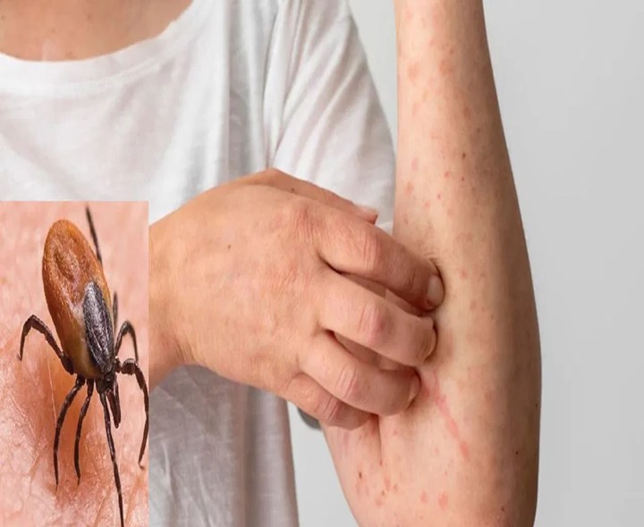 అమెరికాలో ‘టైఫస్’ భయం