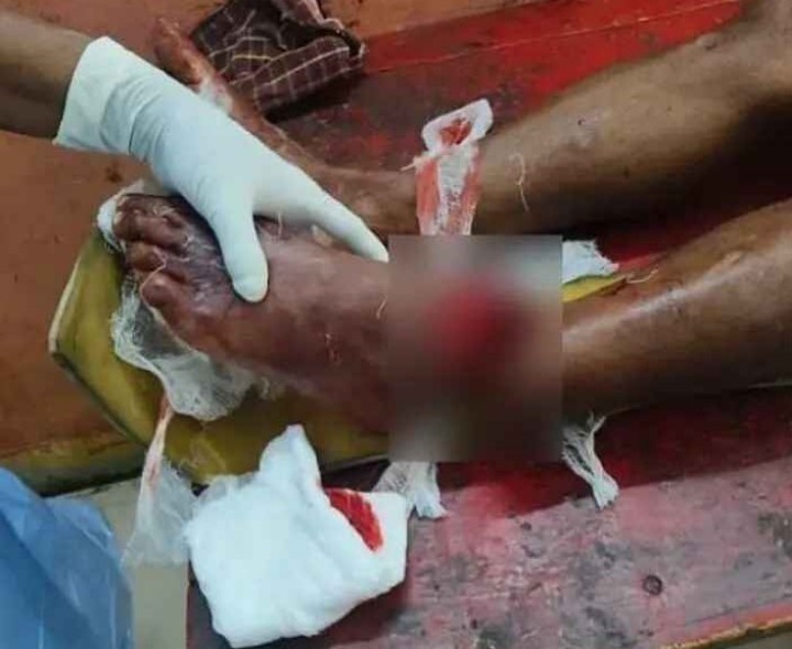 స్టోన్ కటింగ్ మిషన్ కాలిపై పడి వ్యక్తికి తీవ్రగాయాలు