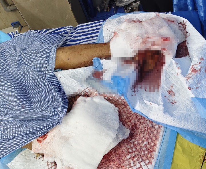 రైలు ప్రమాదంలో మహిళకు తీవ్ర గాయాలు