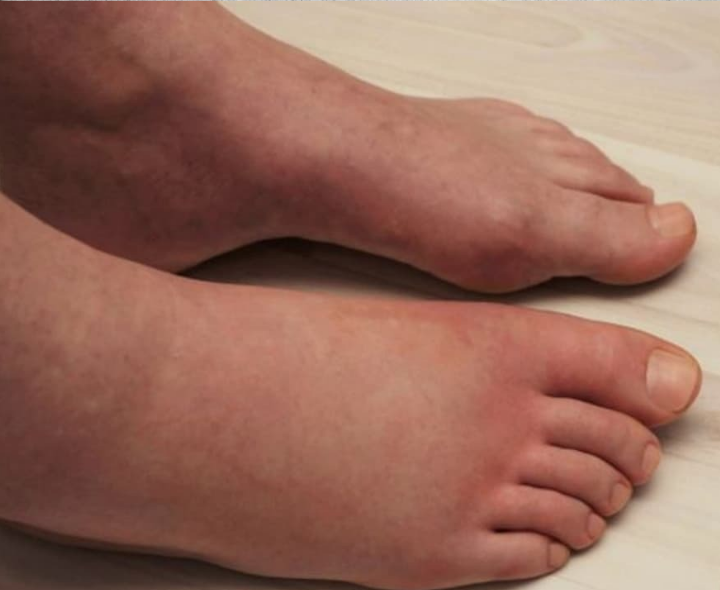 ప్రెగ్నెన్సీలో కాళ్ల వాపులు ఎందుకు?