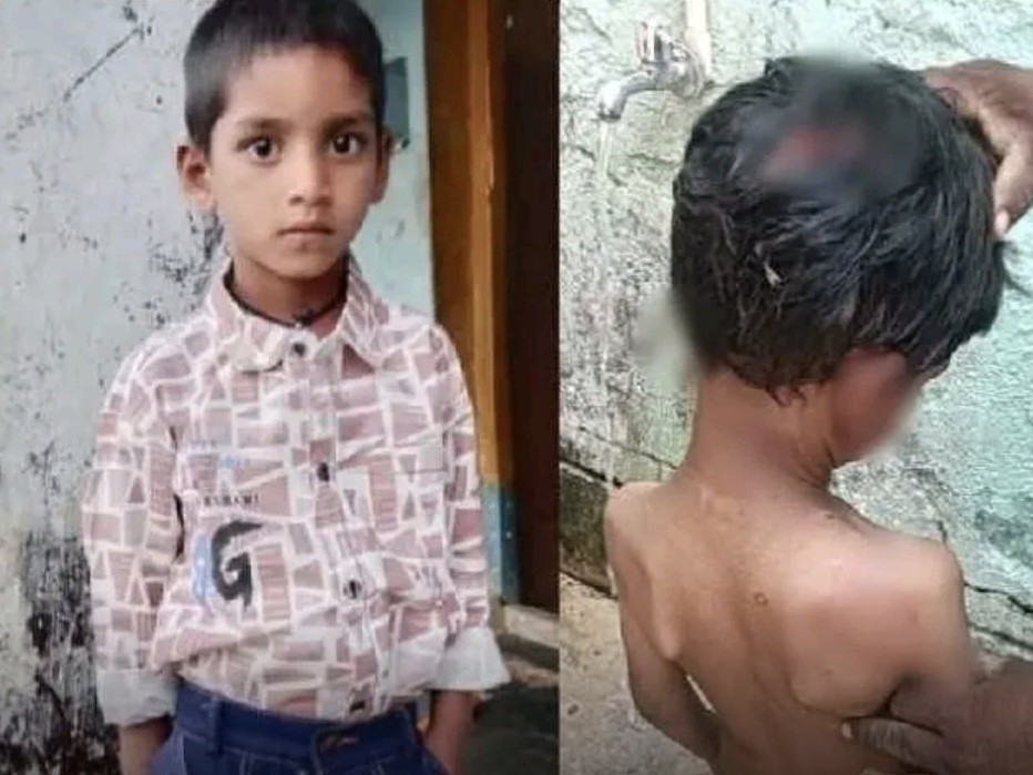 దారుణం.. కుక్కకాటుతో బాలుడి మృతి