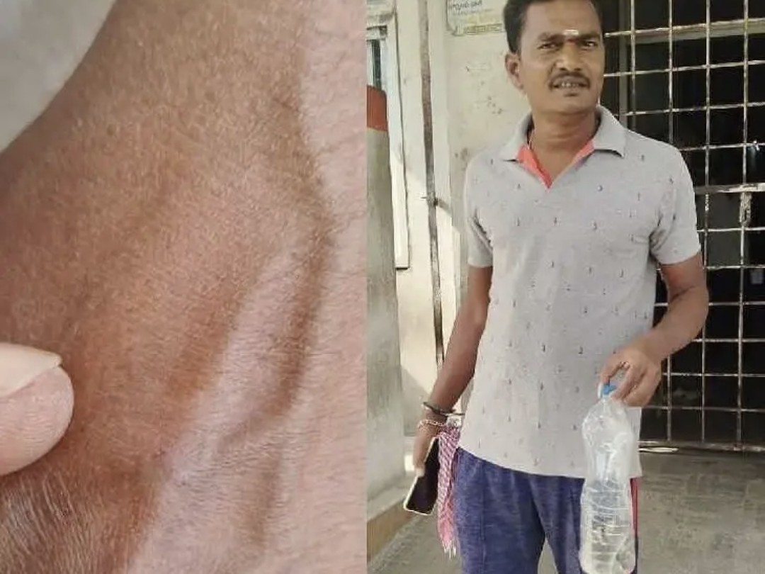 కాటేసిన పాముతో నేరుగా ఆసుపత్రికి