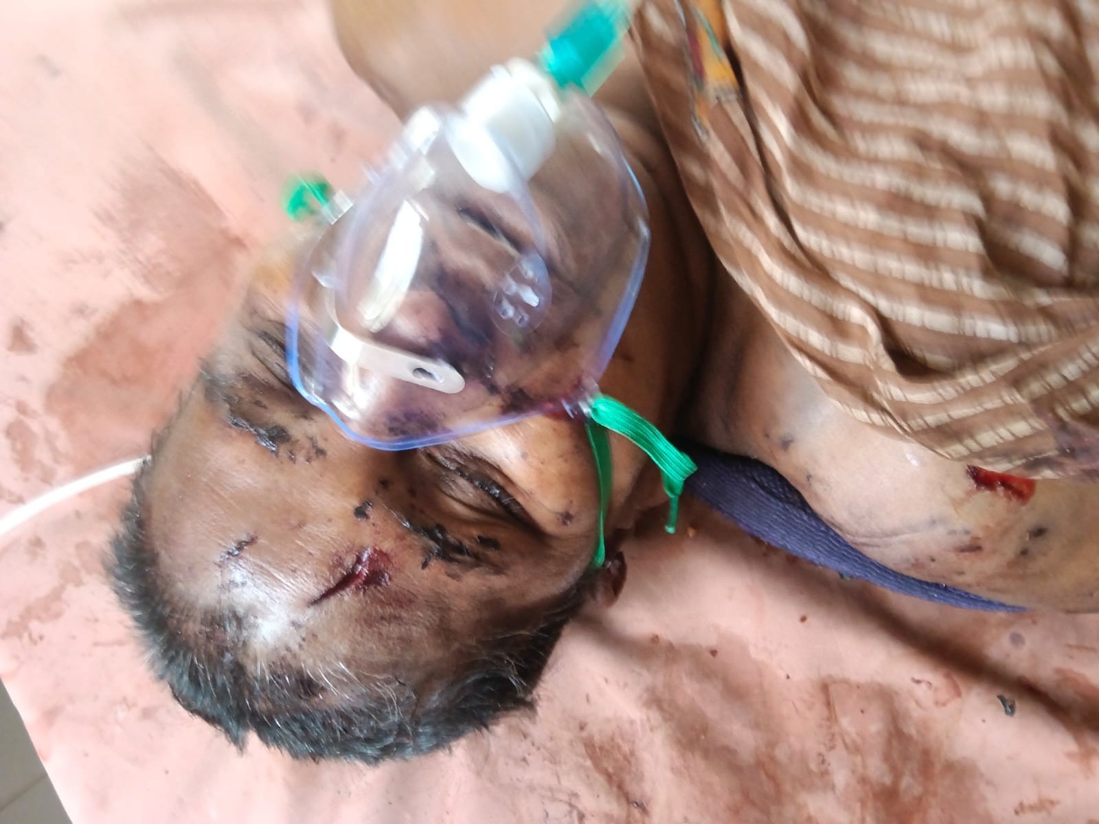 వీధి కుక్కలా దాడిలో మహిళ మృతి